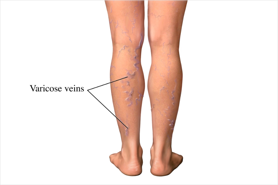 Varicose Veins Treatment graphic
