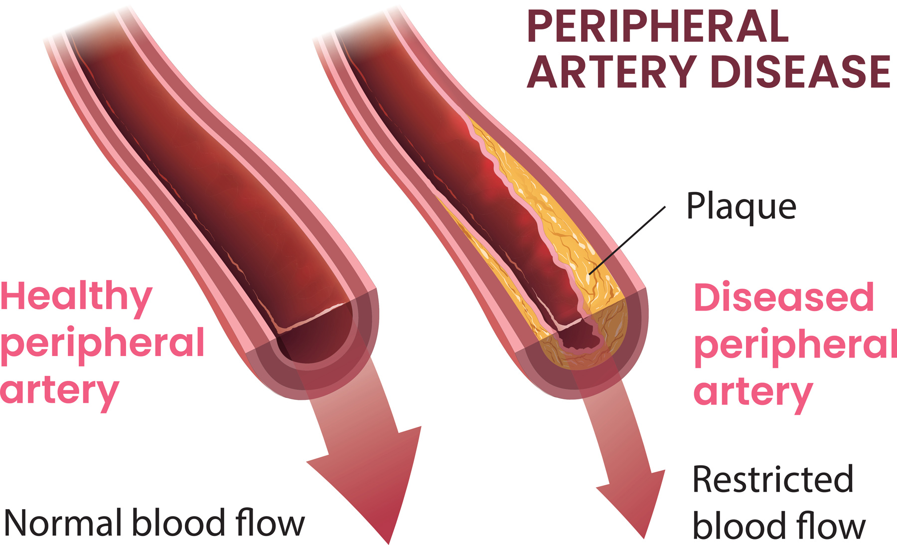 Peripheral Artery Disease Treatment graphic
