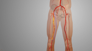 An example of Peripheral Artery Disease