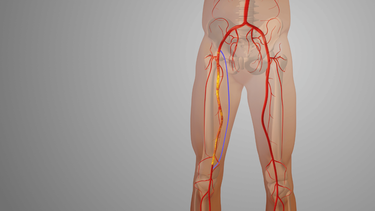 An example of Peripheral Artery Disease